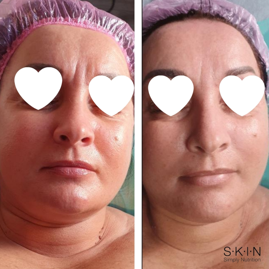 skinsn-blog-efekty-po-aplikacji-maski